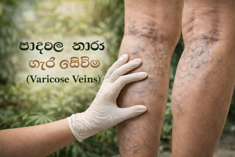 පාදවල නහර ගැට ගැසීම (Varicose Veins) සඳහා සාර්ථක පාරම්පරික ප්‍රතිකාර