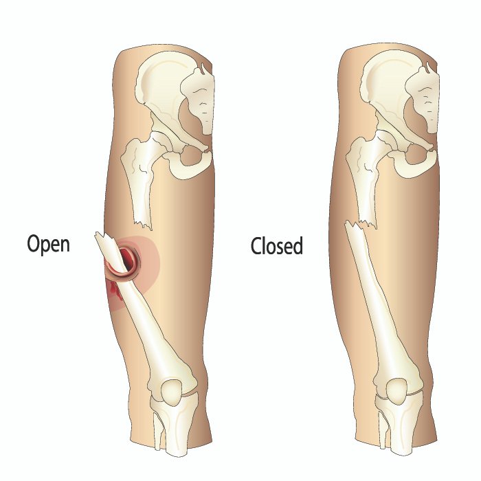 අස්ථි බිඳීම් සහ කොඳු ඇට පෙළේ ආබාධ