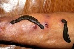 කුඩැල්ලන් මගින් රුධිර පිරිසිදු කිරීම